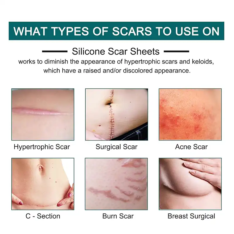 Silicone Scar Tape Silicone Scar Tape