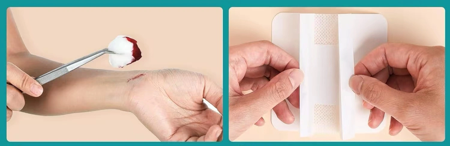 Sterile Wound Dressing Sterile Wound Dressing