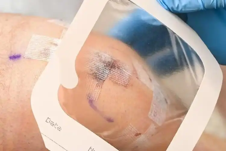 The Role of IV Transparent Dressing in Reducing Bloodstream Infections