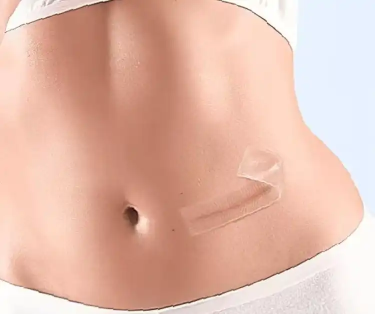 Silicone Scar Tape: Your Secret Weapon Against Hypertrophic Scars