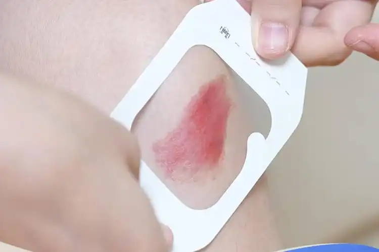 IV Transparent Dressing: Balancing Breathability and Waterproof Protection