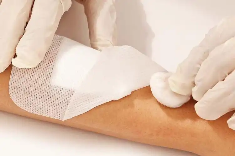Why Choose Non Woven Wound Dressing for Burns?