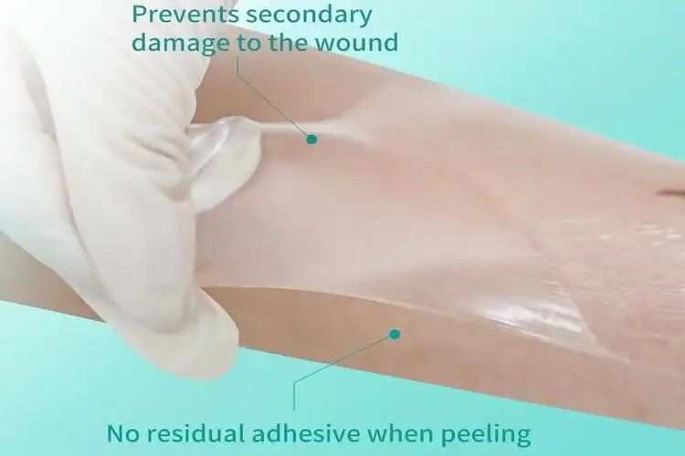 Best Transparent Dressing for Waterproof and Breathable Protection