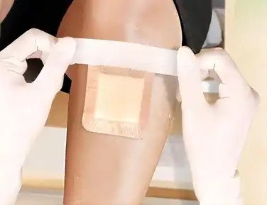 Foam Dressing with PU Film: The Future of Exudate Management